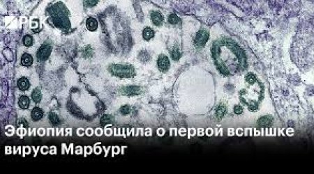 Efiopiyada təhlükəli virusun yayıldığı təsdiqlənib