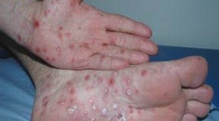 Konqoda Ebola epidemiyası: yoluxanların sayı 5 656-ya çatıb