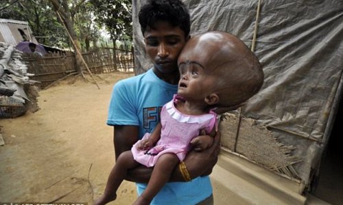 Сложная операция над девочкой с огромной головой -ФОТО