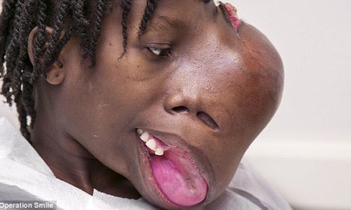 Haitian teen has FOUR-POUND tumor removed from her face - PHOTO