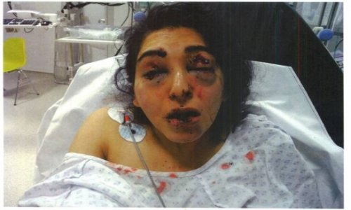 Woman left partially blinded in appalling assault - PHOTO