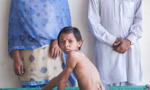 Boy born with with seven-inch TAIL worshipped as a God - PHOTO