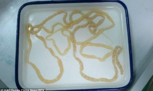 Chinese woman has EIGHT FOOT long tapeworm removed