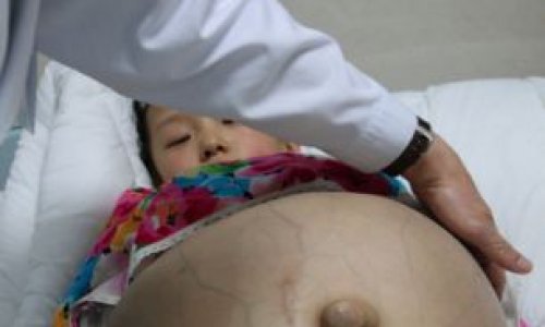 Girl has a watermelon-sized tumour removed from her ovaries - PHOTO