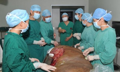 Man has world's 'largest tumour' removed from his leg - PHOTO