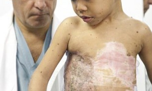 Boy had giant 'turtle shell' mutation removed from his back - PHOTO