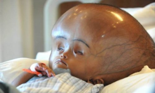 Toddler who survived horrific brain swelling could attend school