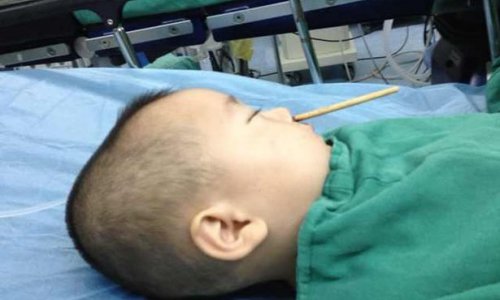 Boy has CHOPSTICK removed from brain after shoving it up his nose - PHOTO