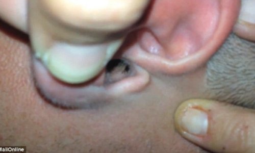 LIVE inch-long moth and a tick are pulled out from a man's ear - PHOTO+VIDEO