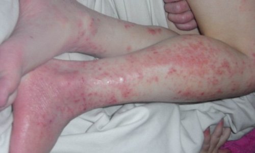 Eczema girl's agony is over - VIDEO