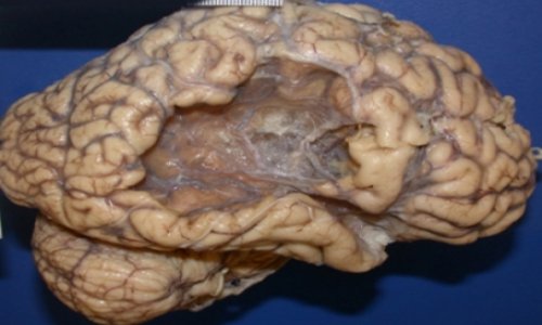 Brain of a stroke survivor