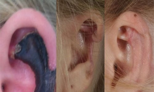 Woman's ear turns black spider bite