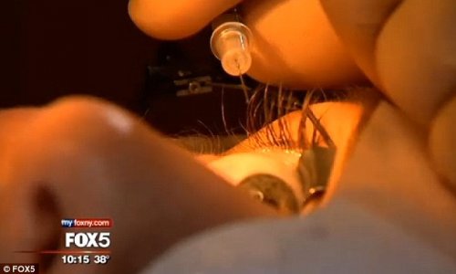 Woman gets platinum jewelry implanted in her optic membrane - PHOTO