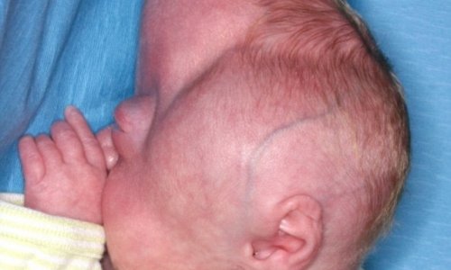 Baby with misshapen head undergoes pioneering surgery - PHOTO