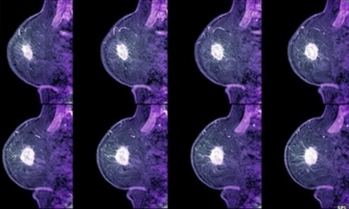 Drug 'halves' breast cancer risk