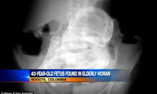 Woman with stomach pain is found to have a 40-year-old fetus inside her