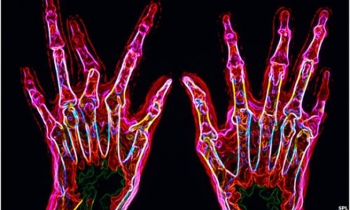 New genetic clues for rheumatoid arthritis 'cure'