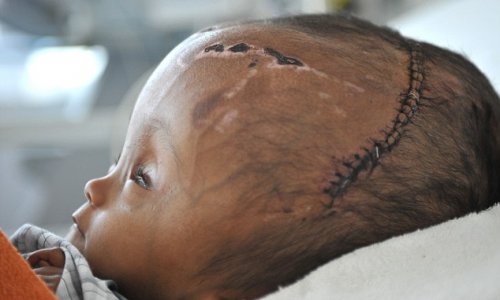 2-year-old has successful surgery to reduce huge swelling - PHOTO