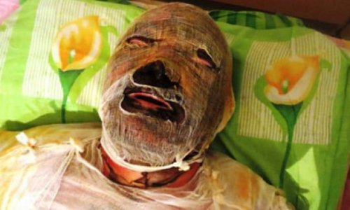 Karabakh war veteran dies of burns in hospital