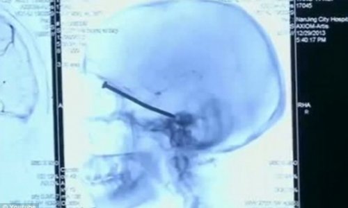 Man discovers three inch nail lodged in his head