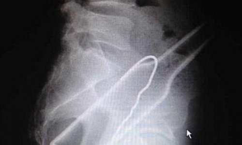 Eye-watering X-rays show bottle stuck in man rear - PHOTO