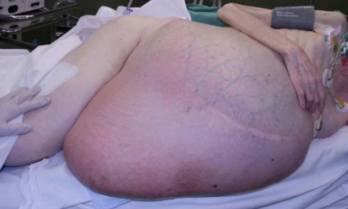 Woman has SIX STONE tumour removed from her stomach - PHOTO