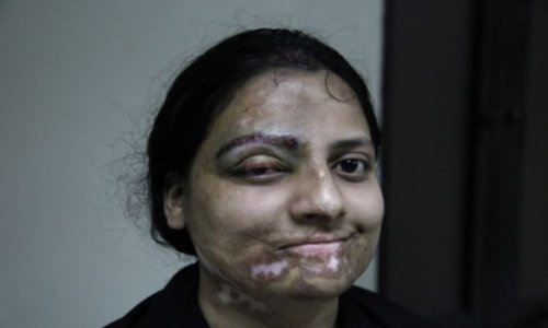 Surgeon provides free treatment to victims of Pakistani acid attacks - PHOTO