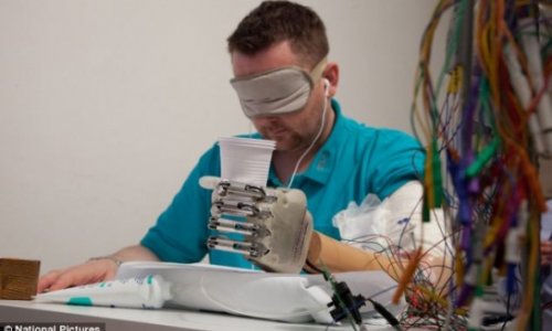 Bionic hand makes patient the first amputee in the world