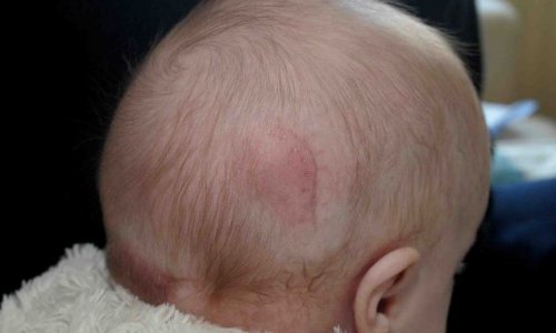 Baby girl born with part of her brain OUTSIDE her skull - PHOTO