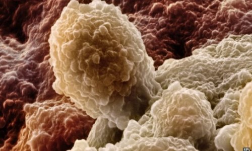 DNA prostate test 'will predict deadliest cancer risk'
