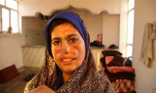 Afghan wife maimed for refusing drug-addict husband's cash demands