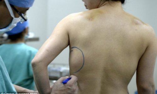 Woman whose implants moved to her BACK and STOMACH - PHOTO