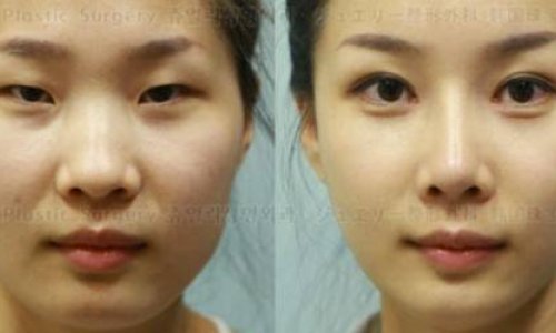 Plastic surgery in South Korea is so good - PHOTO