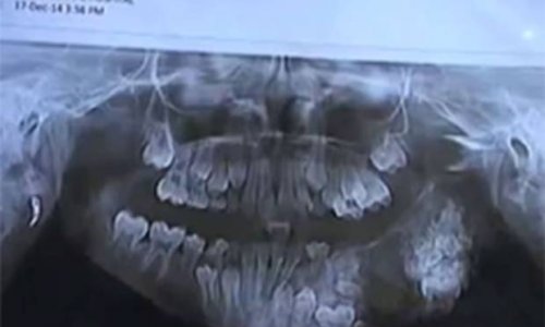 Doctors remove 80 teeth from boy's jaw