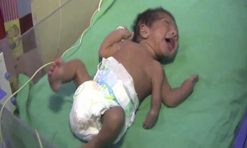Baby born with THREE arms