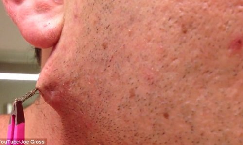 Man pulls the world's longest ingrown HAIR out of his face goes viral