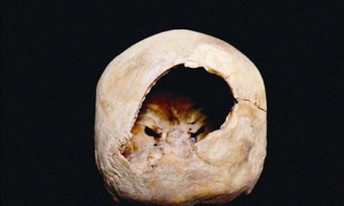 Hole in skull may have been created by craniotomy