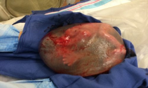 Baby born still INSIDE his amniotic sac