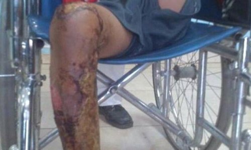 Yemeni boy, 10, locked in a cage and set alight by his friends