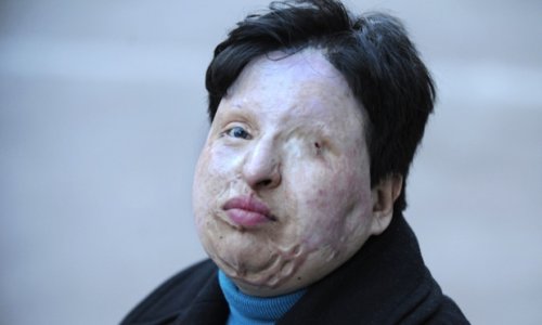 Eye for an eye: Iran blinds acid attacker