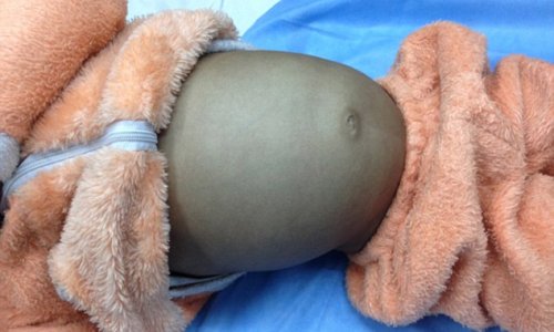 Boy, 4, has huge 4ft hairball removed by doctors