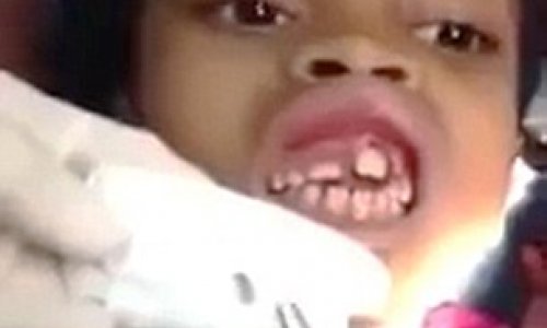 Dentist removing 15 MAGGOTS from inside little girl's gum