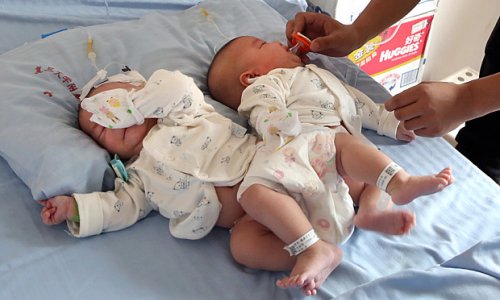 Doctors separate conjoined twins with help of 3D printer