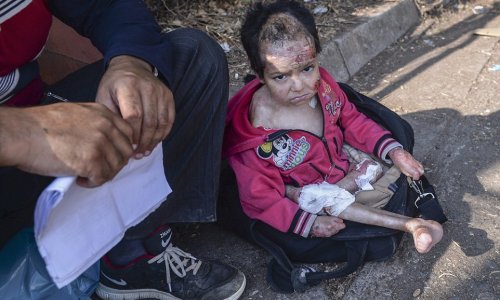 Parents flee Syria with their badly burned little girl