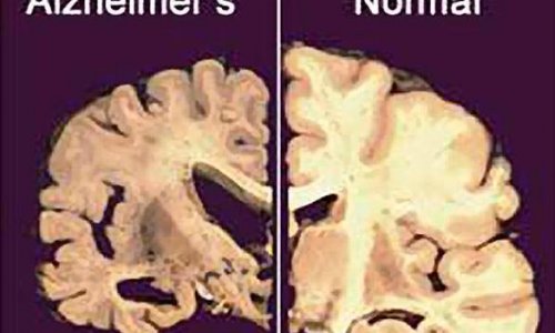 Болезнь Альцгеймера можно победить