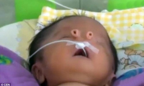 Baby is born with two TUBES on his face instead of a nose
