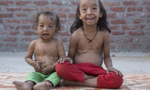 The extraordinary 'Benjamin Button' children