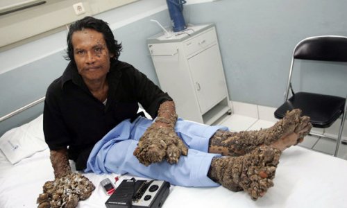 Man who suffered from limbs like TREE TRUNKS dies