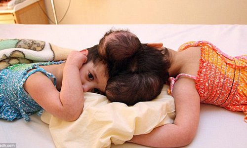 Twin four-year-old girls joined at the head are successfully separated