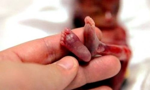 Millət vəkili: Azərbaycanda abortların sayı artır